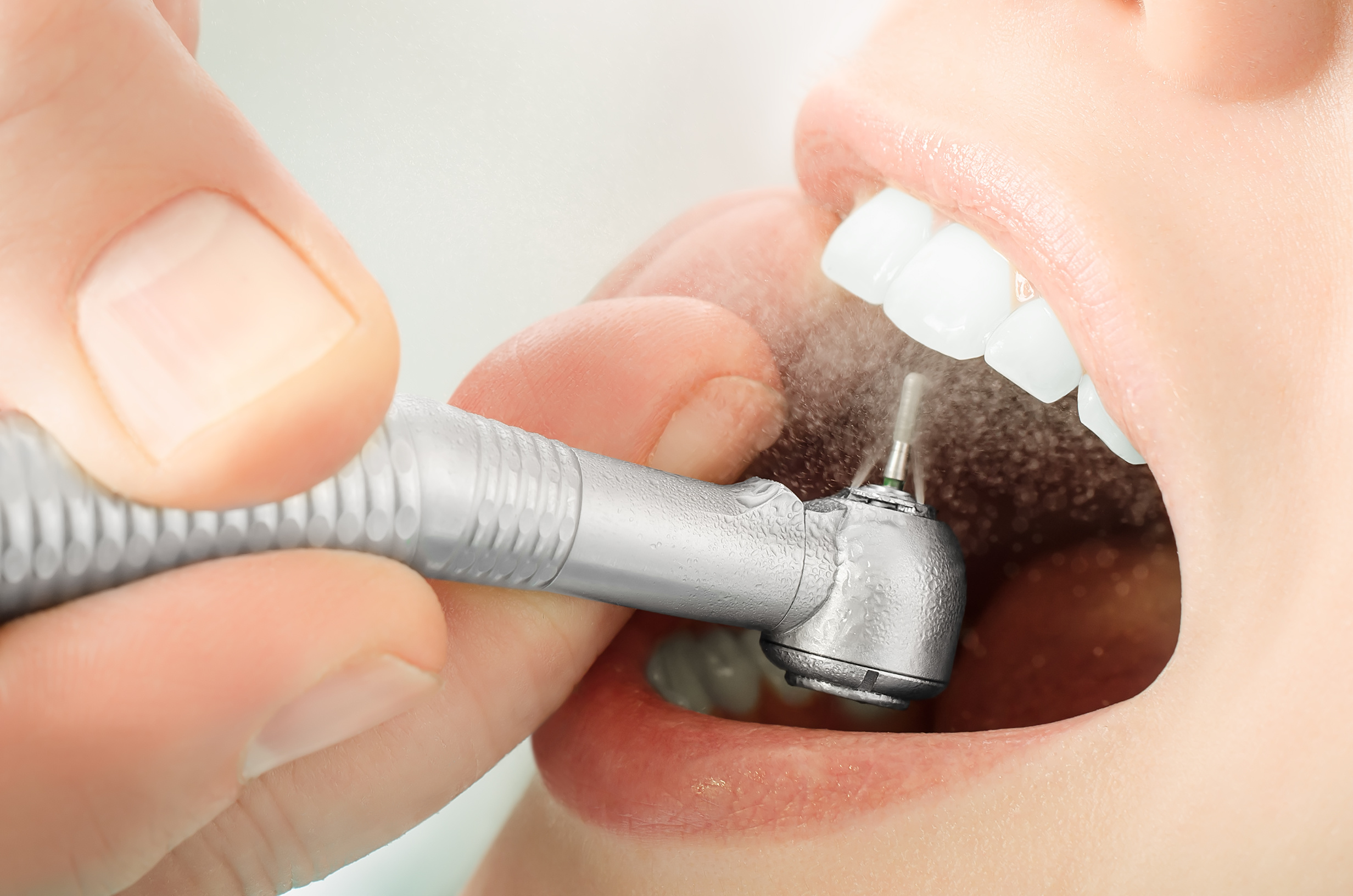 Understanding the Different Types of Dental Restorations
