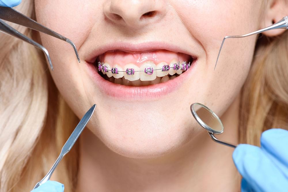 How do orthodontic braces work to straighten your teeth in Fullerton, CA?