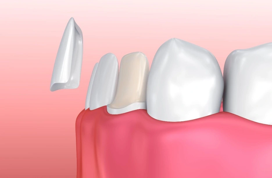 What are 3 Common Types of Dental Veneers? 
