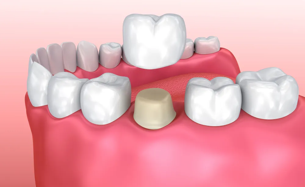Emergency Dental Crowns: What to Do When You Need Immediate Treatment in Omaha